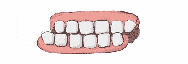 夜间磨牙可引起齿龈炎和牙周炎,使牙齿过早地松动脱落.