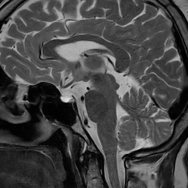 医影学堂丨空泡蝶鞍的影像学特点,这三个征象要会看