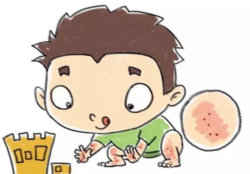沙土皮炎医学上又  称摩擦性苔藓样疹,是一种常见于学龄前期儿童,好