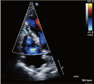 经胸超声心动图可清楚看到室间隔穿孔位置,大小及分流情况