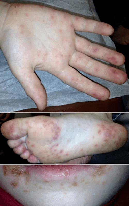 孩子手脚有皮疹可不一定是蚊子叮的这种病毒要当心