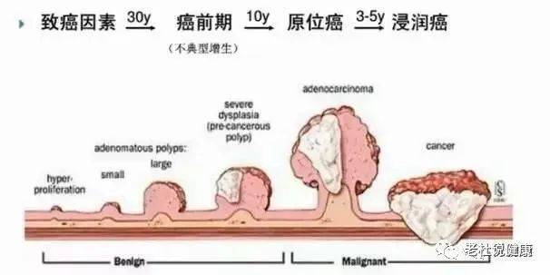 肠息肉切除后,3年不复查;便血腹痛再来查,结果是晚期肠癌