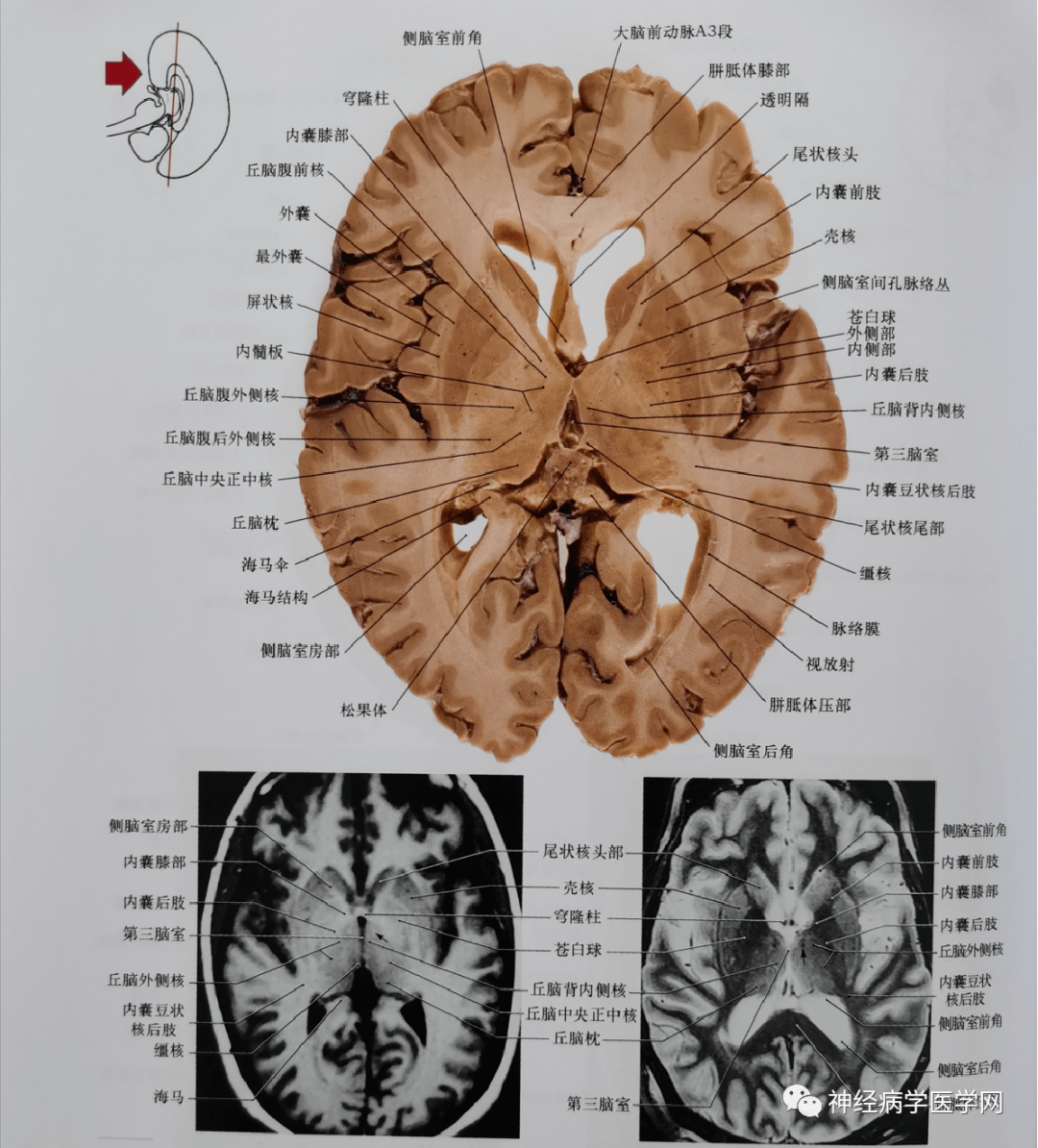 侧脑室后角及小脑,包括部分小脑外侧核平面的冠状位影像
