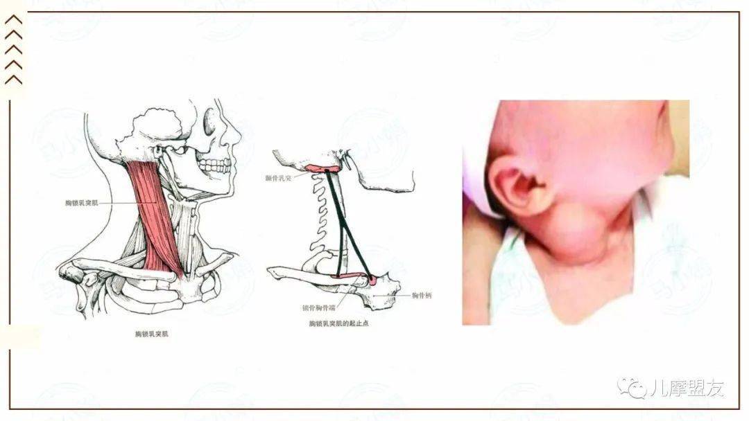 【医文医话】宝宝脖子歪歪,家长不可忽视的"小问题"