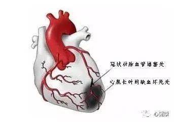 心肌梗死越重,越需要急诊手术