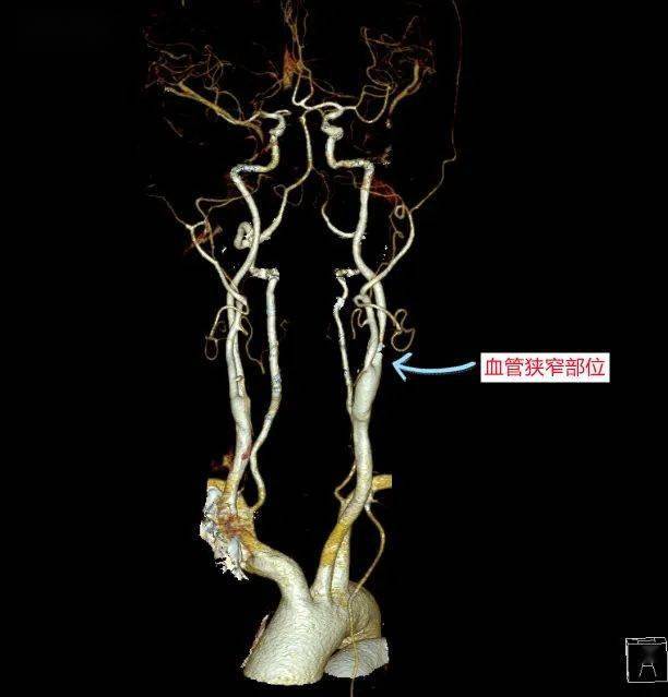 城医技术 神经外科为脑血管狭窄患者实施颈动脉内膜剥脱术