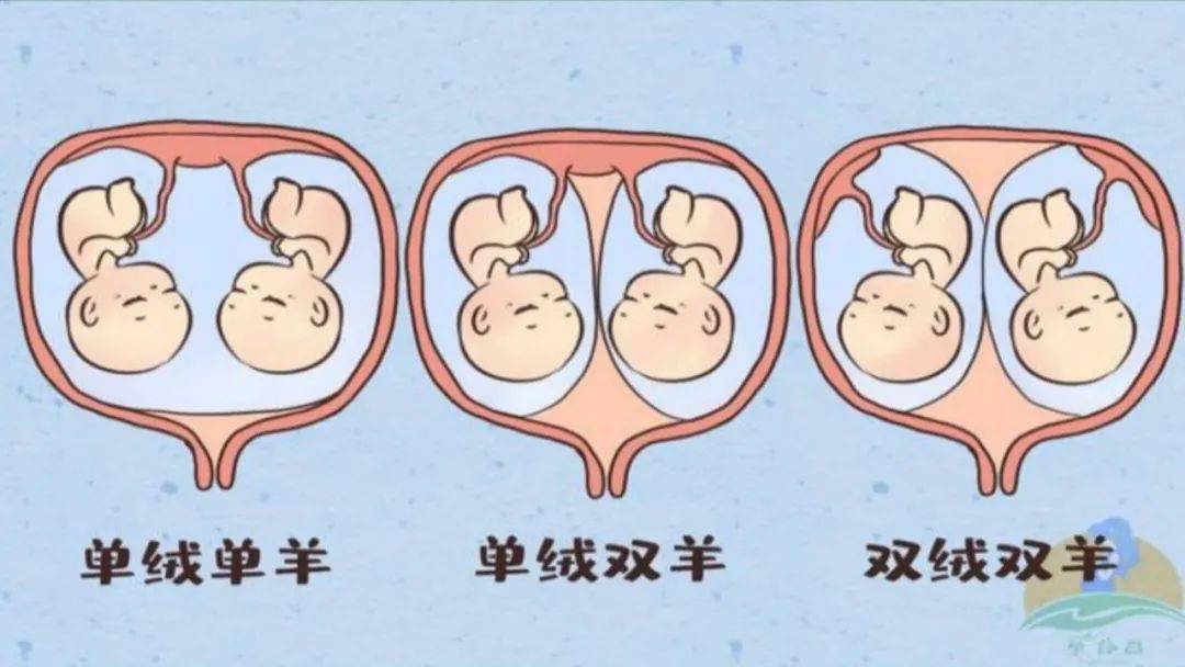 常见的同卵双胞胎分四种,双绒双羊,单绒双羊,单绒单羊和连体双胎