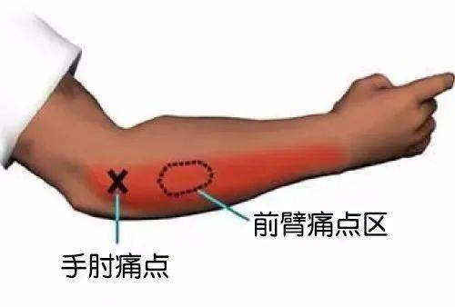 新手妈妈胳膊痛,原来是得了妈妈肘