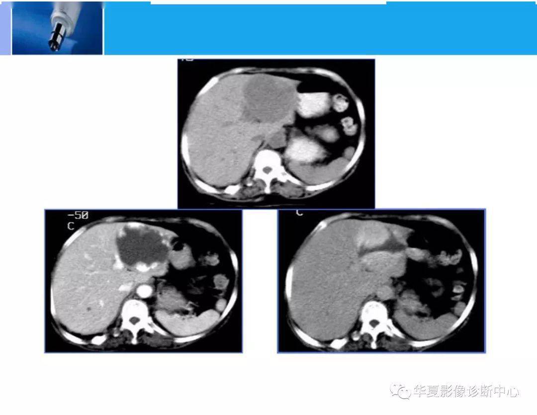 精华全篇:肝脏的ct影像诊断
