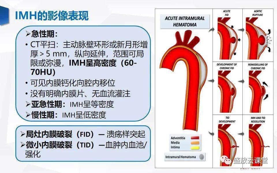 主动脉壁内血肿imh的影像诊断