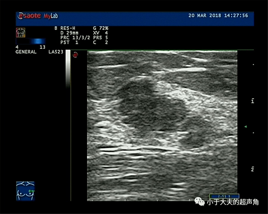 6cm,距乳头约2cm腺体层内可见大小约1.8 x 1.