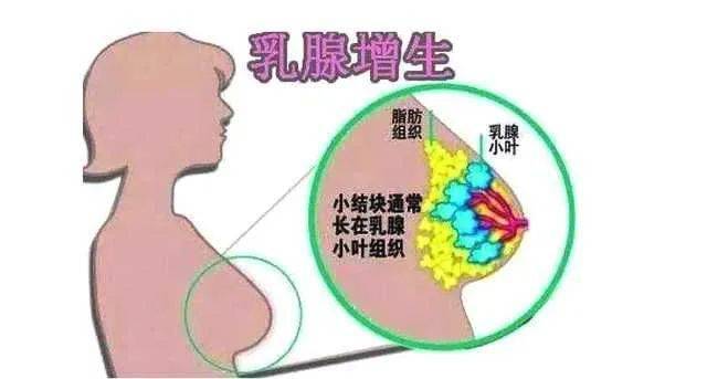 乳腺增生的症状  乳腺增生最明显的症状就是乳房疼痛, 就是女性朋友