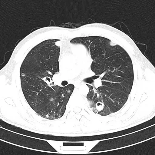 ct:双肺多发空洞,气囊,结节,病灶以胸膜下为主,见实变,胸腔积液.