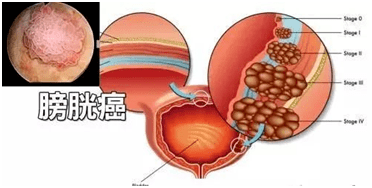 【2021年全国科普日│友谊老年肿瘤】膀胱癌到来不是无声无息的