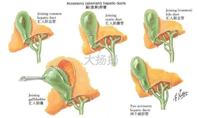 胆囊管的变异(图片源自《奈特人体解剖学彩色图谱)