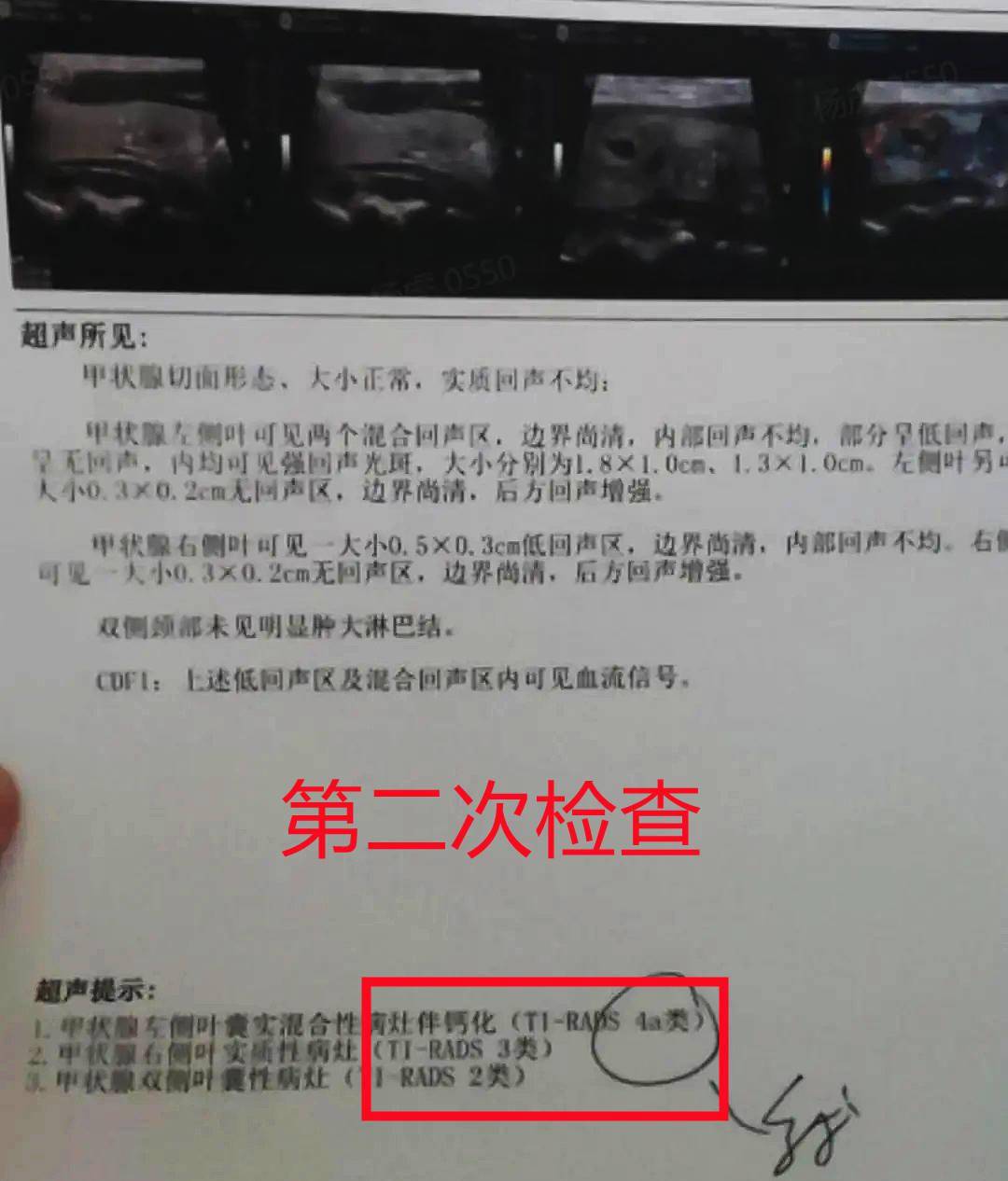 4次b超确诊4a类甲状腺结节患者不接受手术最终选择保守治疗