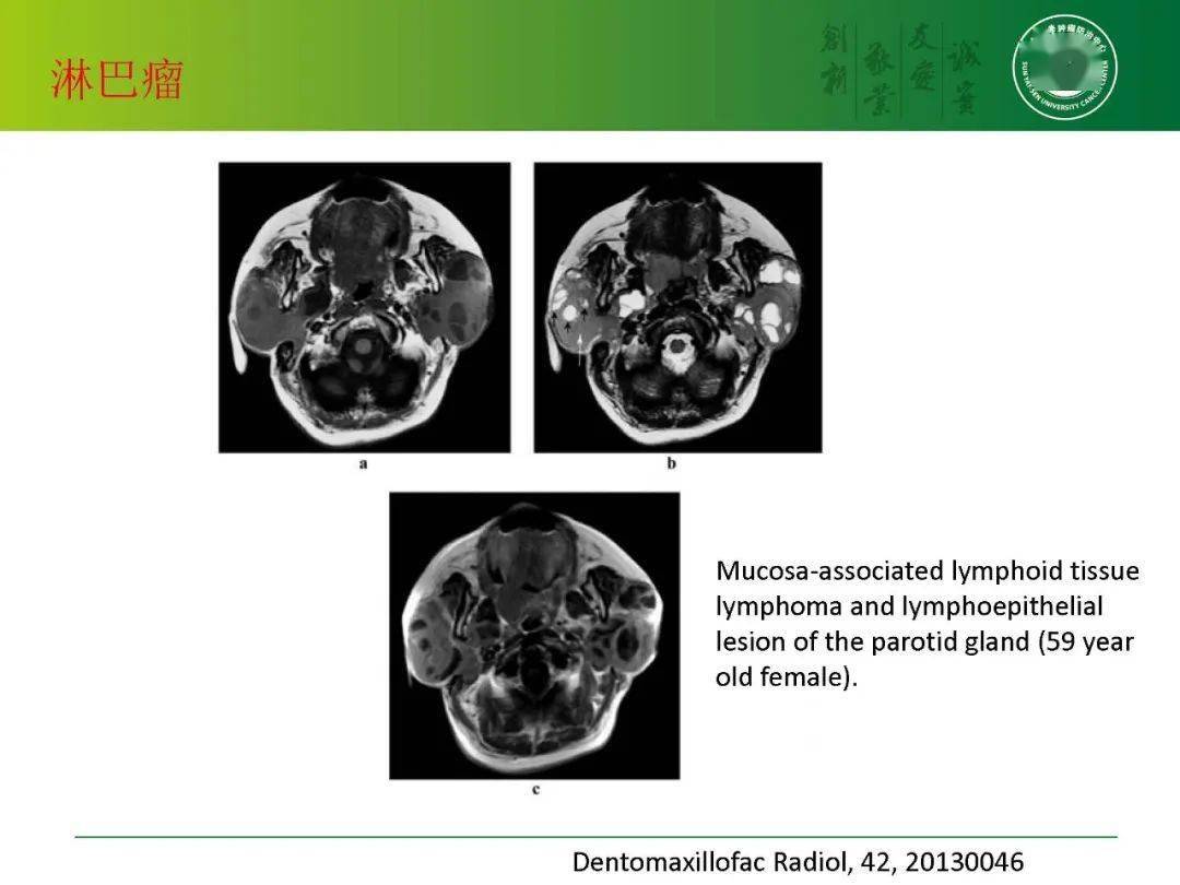 腮腺肿瘤的影像诊断要点