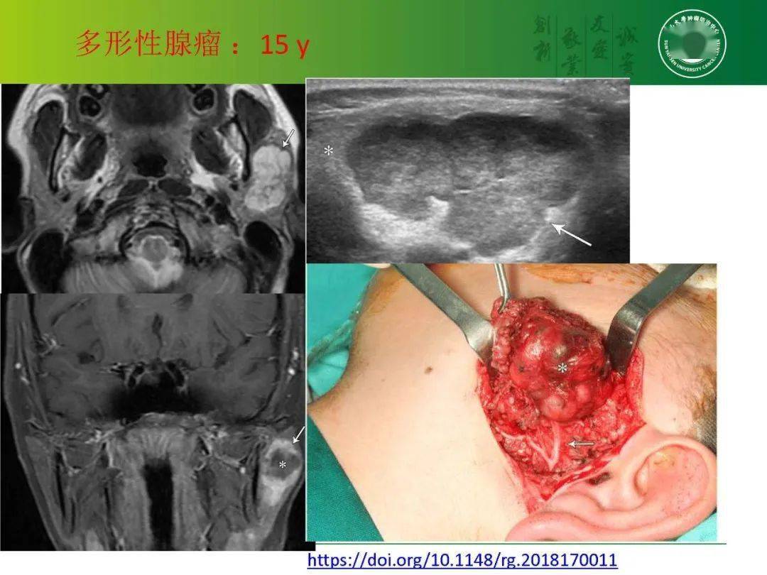 腮腺肿瘤的影像诊断要点