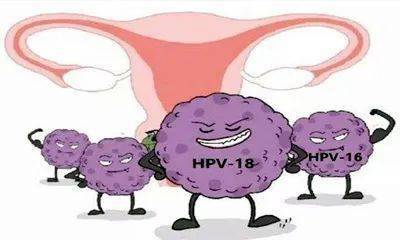 人乳头瘤病毒(hpv)感染是常见的女性下生殖道感染,属于性传播感染.