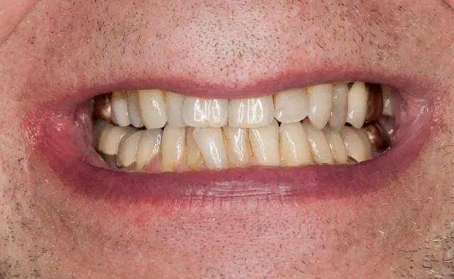 不均匀分布的黄色"泥土",就是黄色牙菌斑了,这也是牙齿发黄的原因