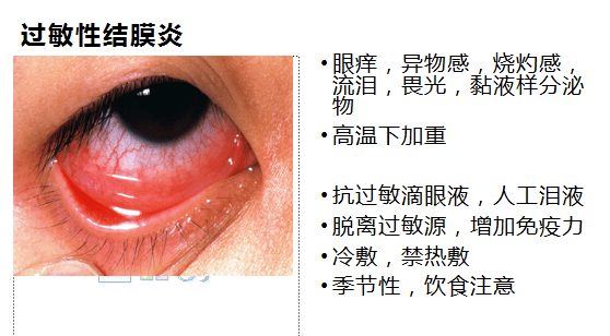 尽管过敏性结膜炎看上去因眼睛里布满血丝,眼睛发红,但它和感染性
