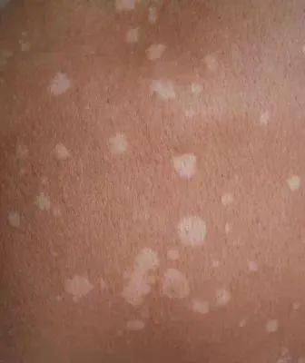 汗斑又称花斑糠疹,是发生在胸背部位常见的浅表真菌感染性皮肤病