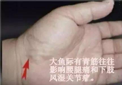 3,手掌青筋 (1)大鱼际有青筋,往往提示腰腿痛和下肢风湿关节痛.