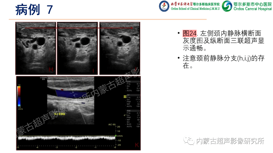 上肢深静脉血栓的超声检查