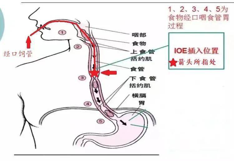 康复医学科有个特色治疗,可以跟鼻胃管说再见