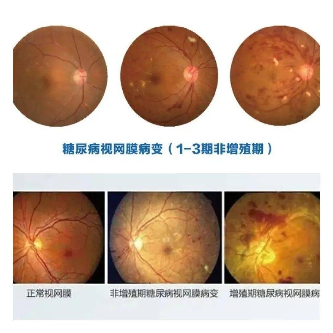 糖尿病视网膜病变不同时期的病变情况