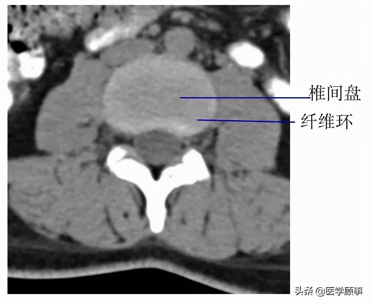 脊柱详细解剖,高清图文_颈椎