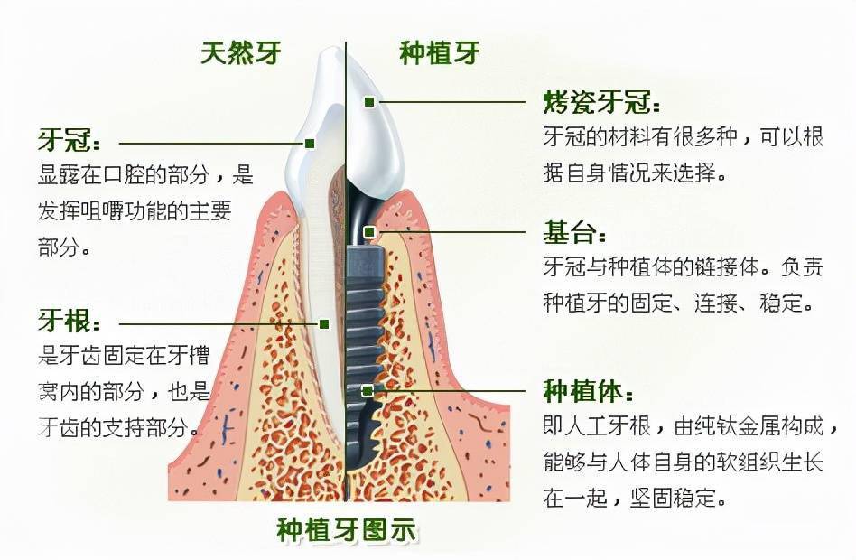 种植牙图解种植牙需满足3个条件虽说种植牙基本是牙齿缺损人群的第一