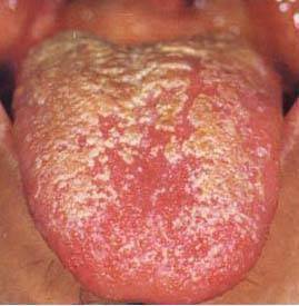 舌苔浮于舌面,刮之即去,其下不能续生新苔,是由胃气,胃阴大伤,舌苔失