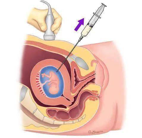 羊膜腔穿刺