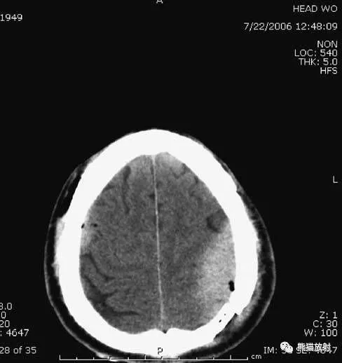 颅脑ct怎么看?正常和异常影像分别是什么?_脑室