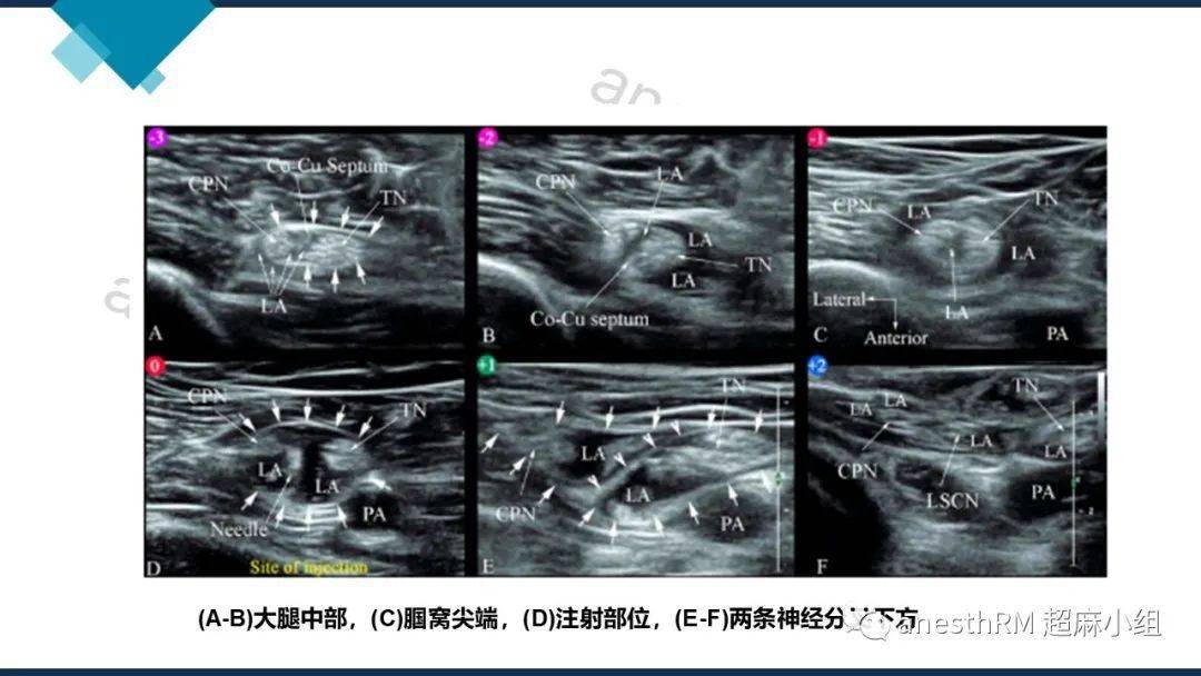 超声引导下腘窝坐骨神经阻滞