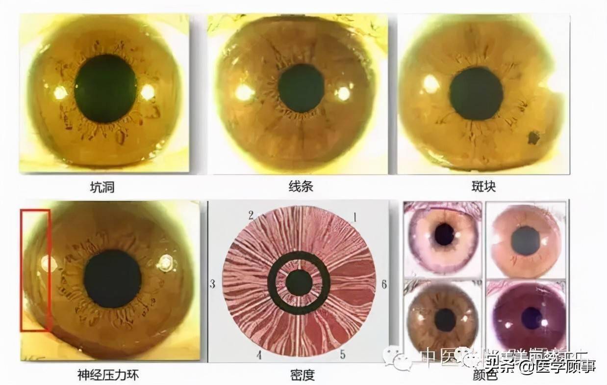 虹膜的六大现象:虹膜学是一种以形态学为基础,通过眼睛虹膜形态的变化