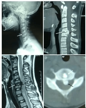 颈椎少见的3种钙化性疾病,大涨见识