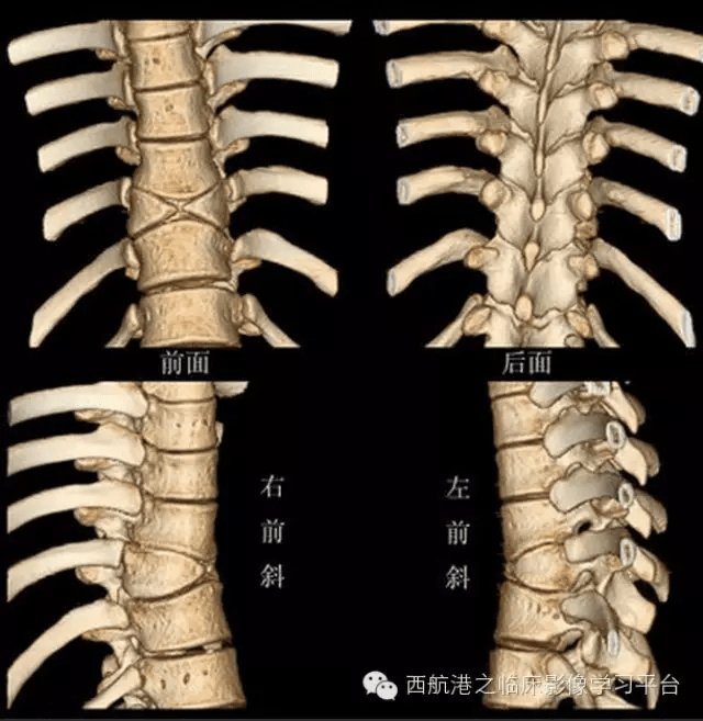 10种脊柱畸形影像表现汇总