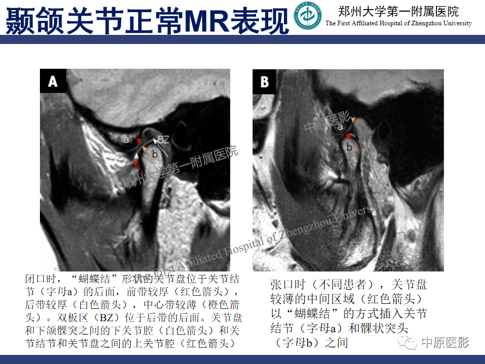 颞颌关节紊乱病的mri诊断