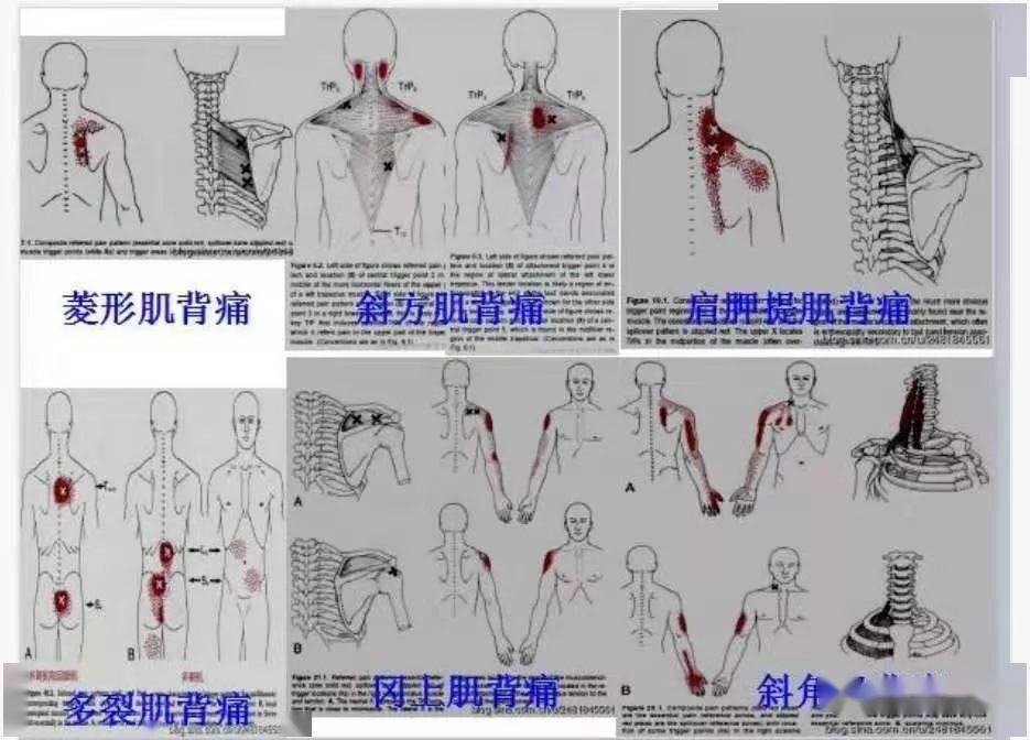 肌筋膜全身160个疼痛触发点