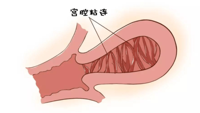 子宫_内膜_人工流产