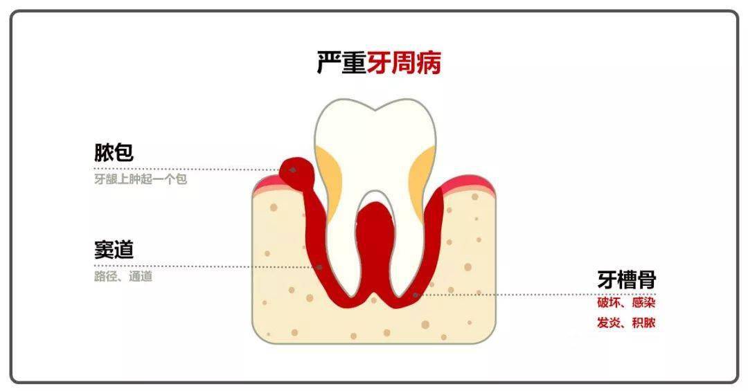 停止自己刺破!_牙齿_牙髓_口腔