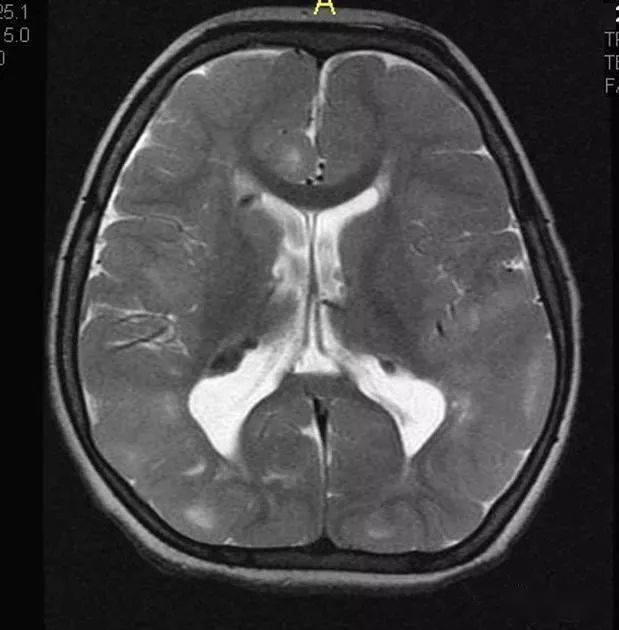 结节性硬化影像表现_钙化_脑室_患者