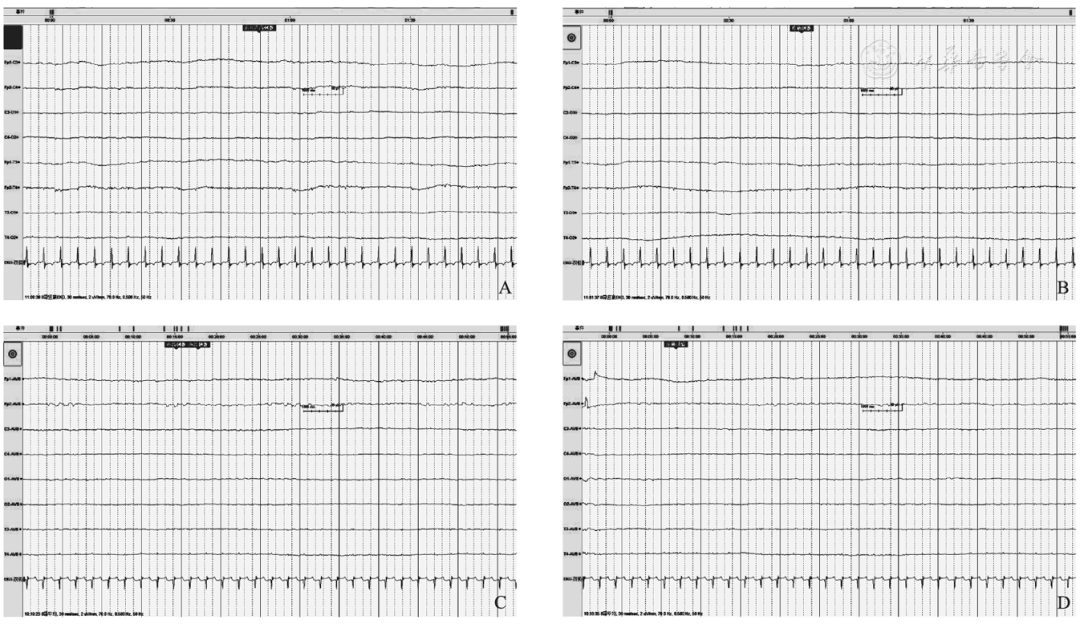 eeg)时程3 h,均显示电静息状态(脑电波活动≤2 μv,符合eeg脑死亡