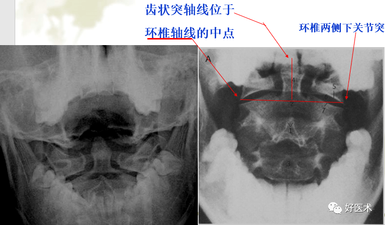 枢椎前结节(1,前弓,齿