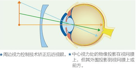 戴上镜片后,视网膜中央会产生清晰的影像,同时视网膜前方会出现离焦或