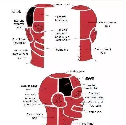 【图中黑色部分为疼痛区域】人类75%的疼痛是由于肌肉的原因,触发点