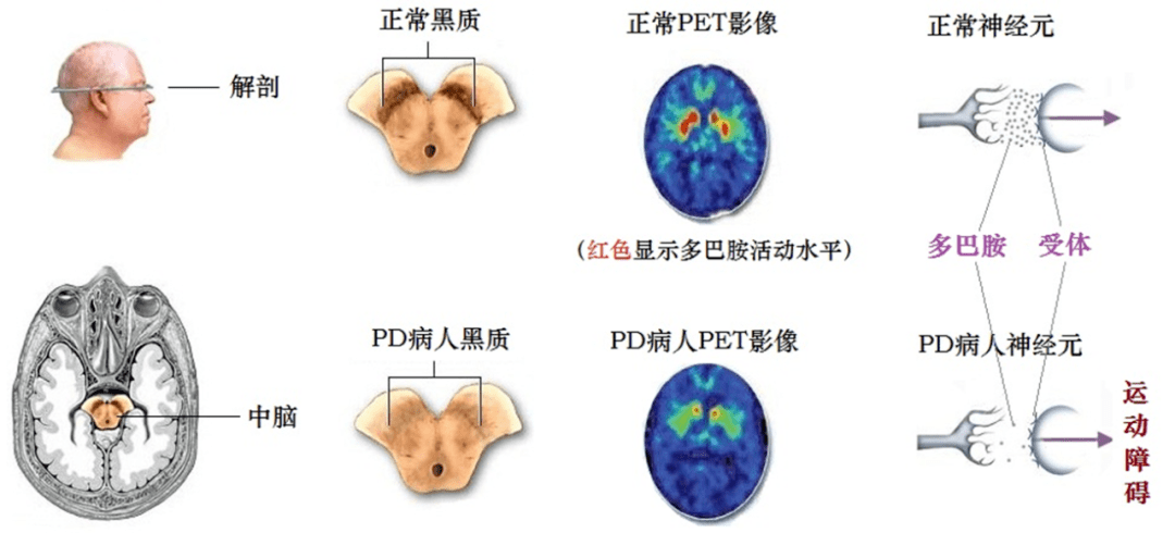 当这些黑质神经元变性死亡达80%以上时,就会出现帕金森病的症状.帕金