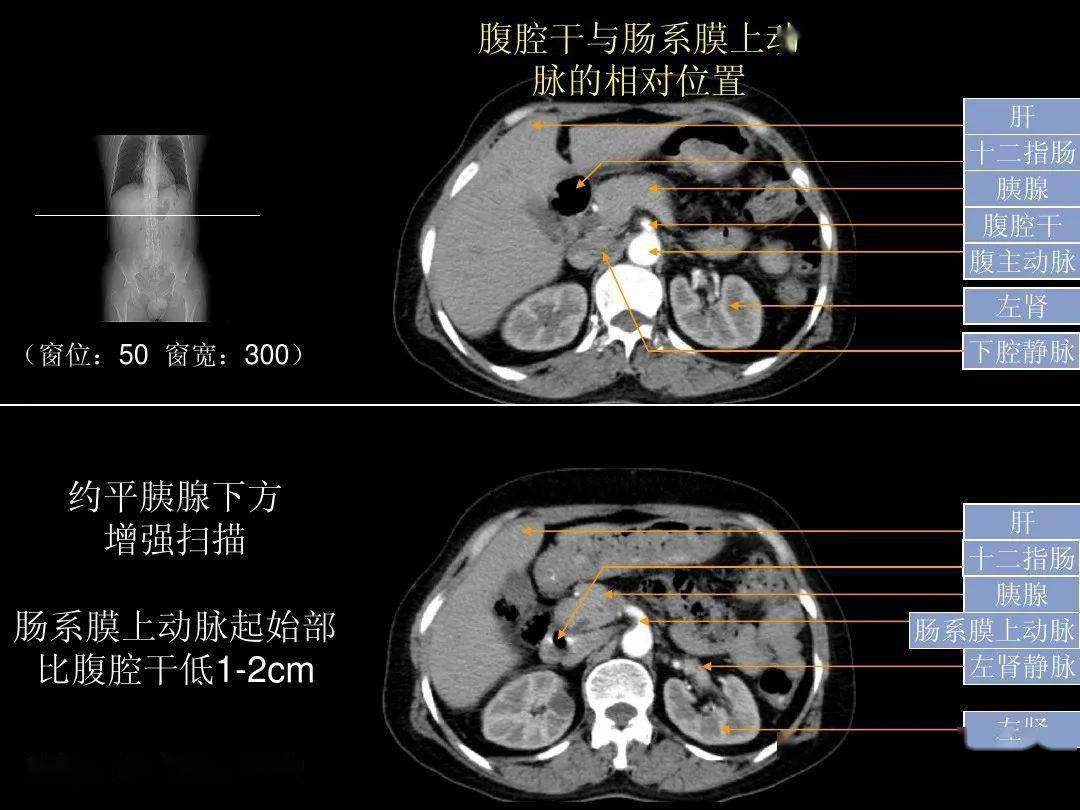 超细的腹部ct入门精美解剖图谱_图像_血管_器官